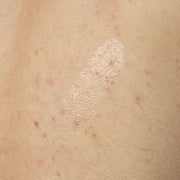 Close-up texture shot of The Ordinary Salicylic Acid 0.5% Body Serum. The clear, lightweight gel is shown applied directly to skin with some visible body acne, demonstrating its consistency.